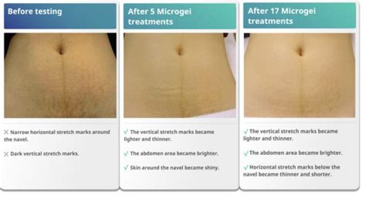 How long do stretch marks take to fade?