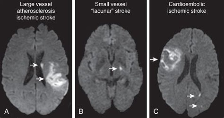 How long does it take for ischemic stroke to show on MRI?