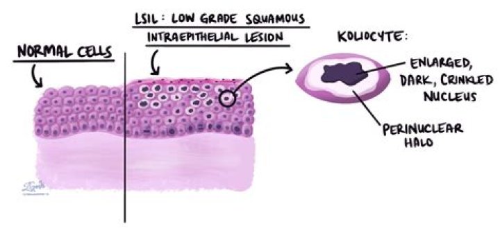How long does it take LSIL to turn into HSIL?
