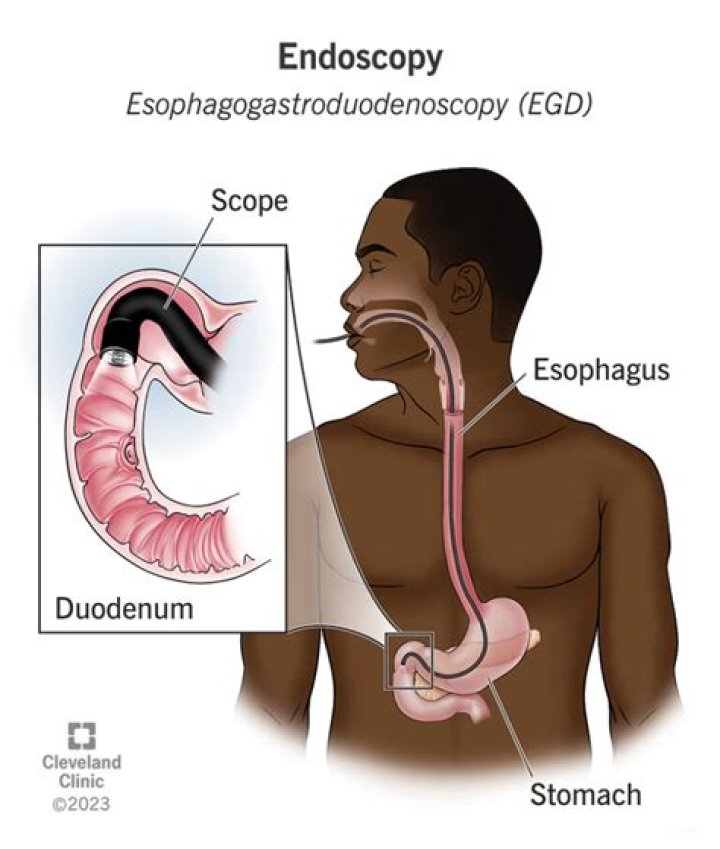 How long does upper endoscopy take?