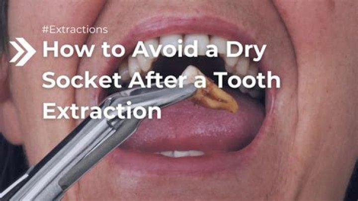 How long should you stay home after a tooth extraction?