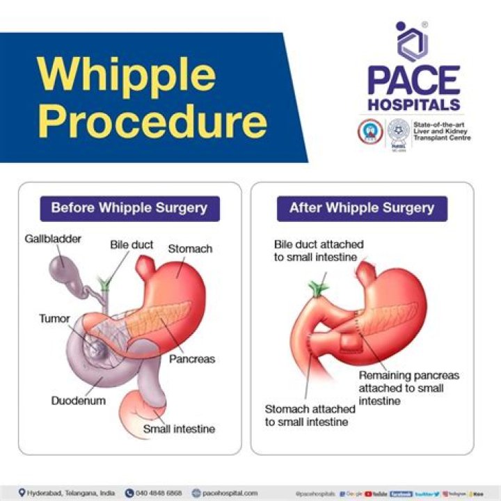 How many hours does Whipple surgery take?