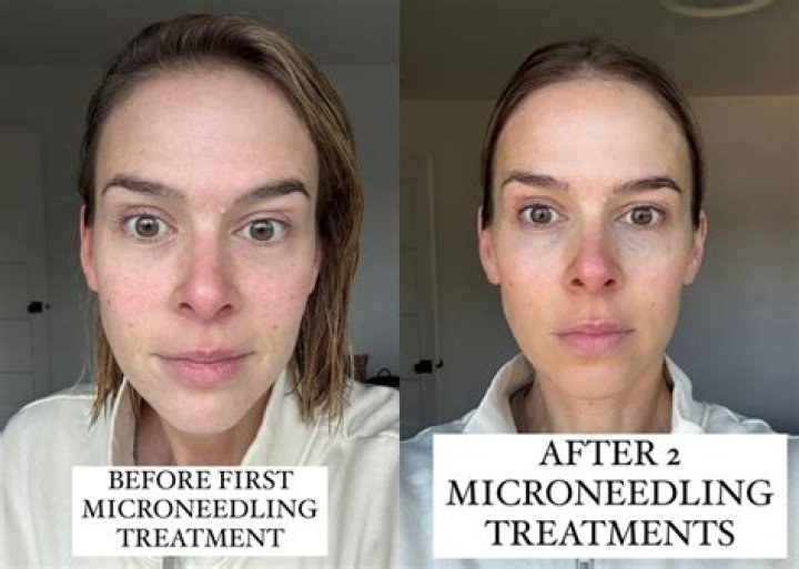 How often should I microneedle for loose skin?