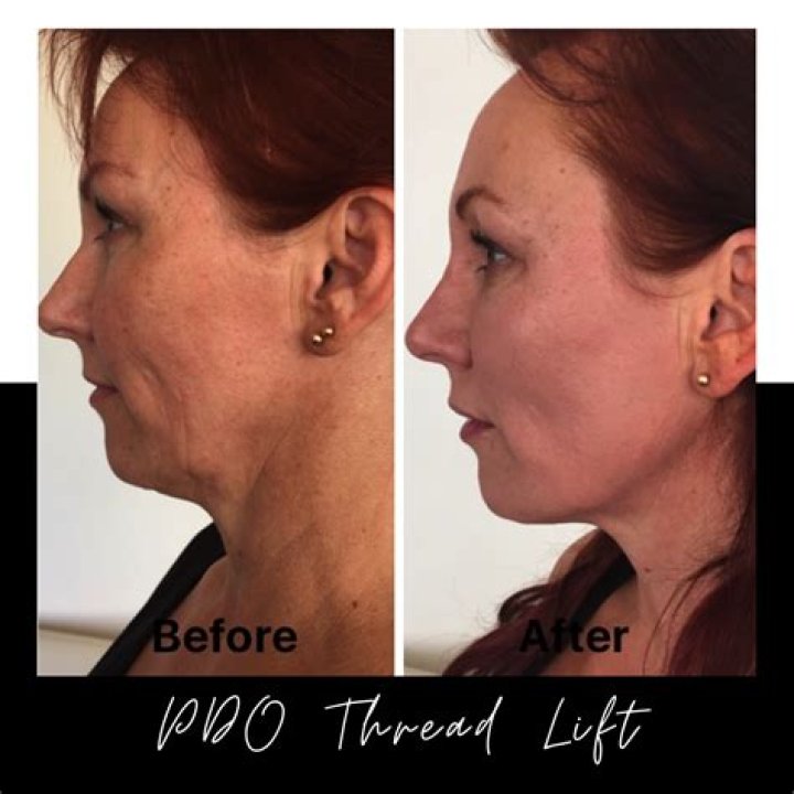 Is a thread lift worth it?