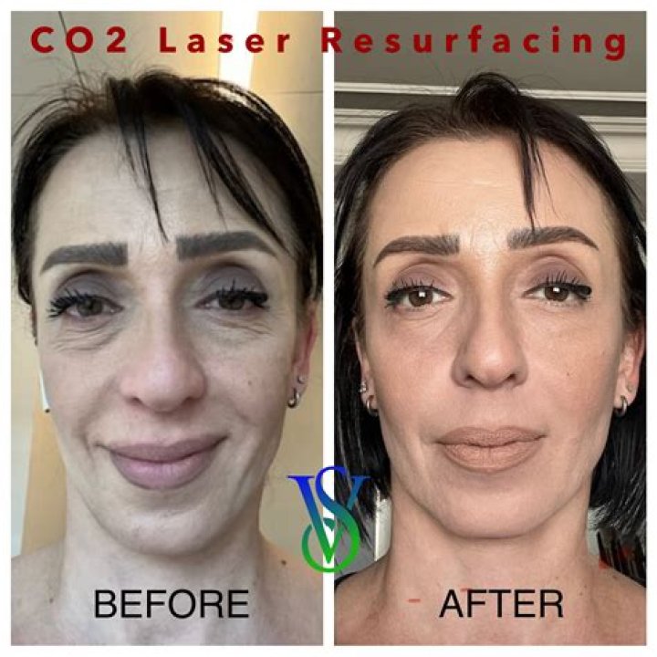 Is CO2 fractional laser safe?