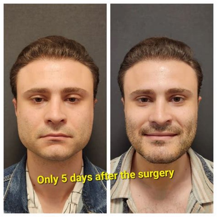 Is jaw surgery scary?