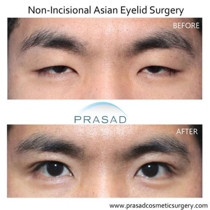 Is non incisional eyelid surgery permanent?