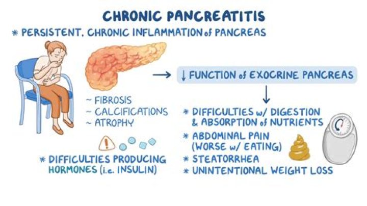 Is pancreatitis difficult to diagnose?