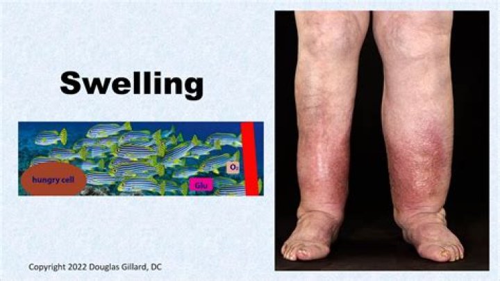 Is swelling worse in the morning?