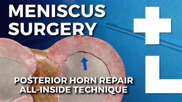 Is there an alternative to meniscus surgery?