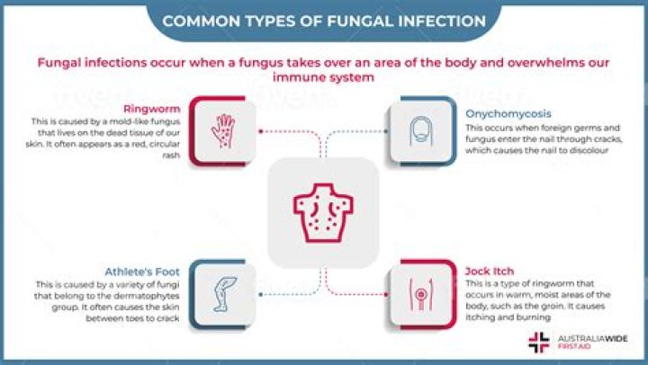What are the 4 types of fungal infections?