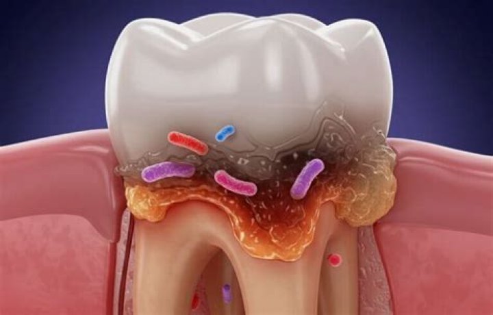 What are the chances of dying from a tooth infection?