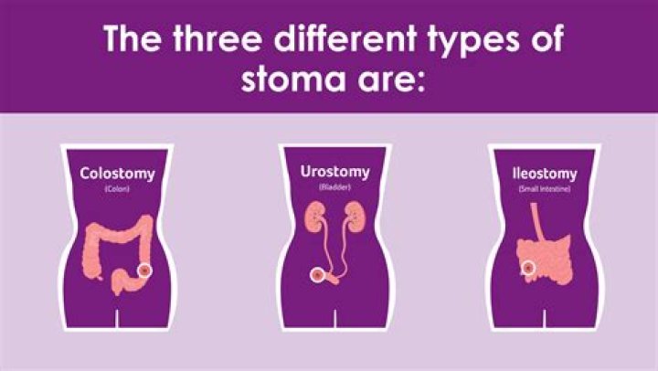 What are the three major problems associated with having a stoma?