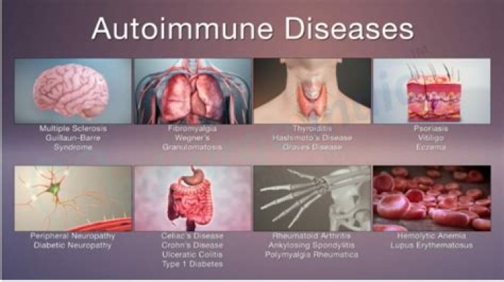 What autoimmune diseases cause a white tongue?
