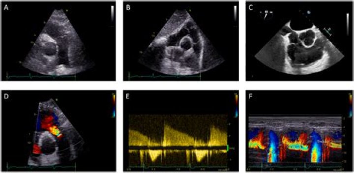 What can an echocardiogram miss?