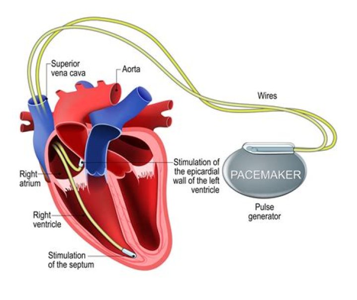 What can interfere with a pacemaker?
