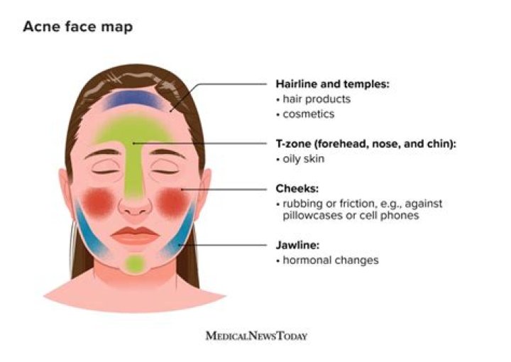 What causes acne on chin?