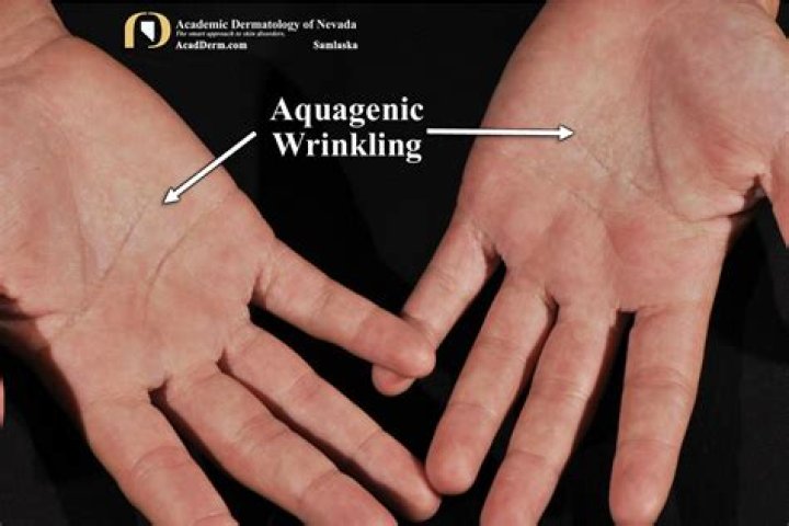 What causes aquagenic wrinkling?
