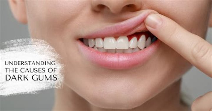 What causes gums to turn grey?