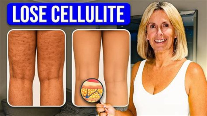 What causes thigh cellulite?