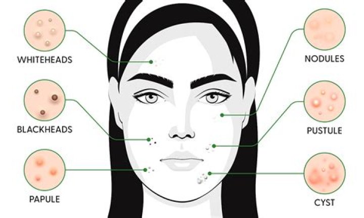 What country has most acne?