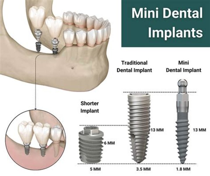 What do dental implants cost on average?