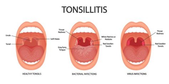 What does a healthy tonsil look like?