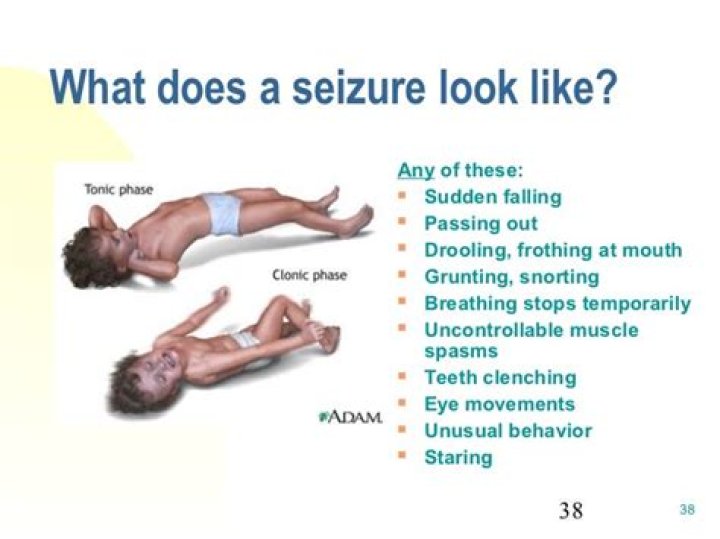 What does a seizure look like?