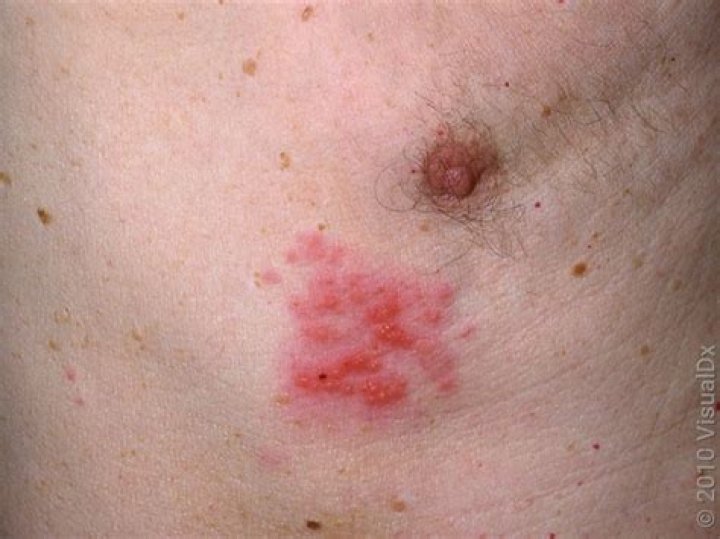 What does a shingles rash look like?