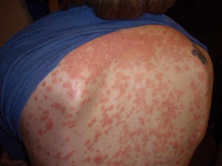 What does guttate psoriasis look like?