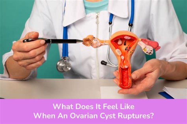 What does it feel like when you have a cyst on your ovary?