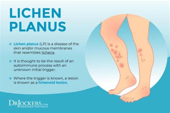 What does lichen planus look like on the toenails?
