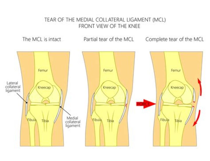 What does MCL pain feel like?