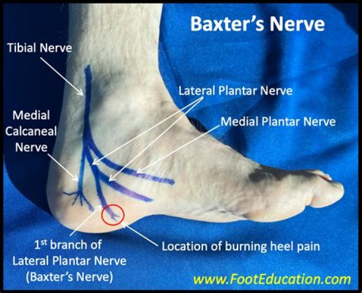 What does plantar nerve entrapment feel like?