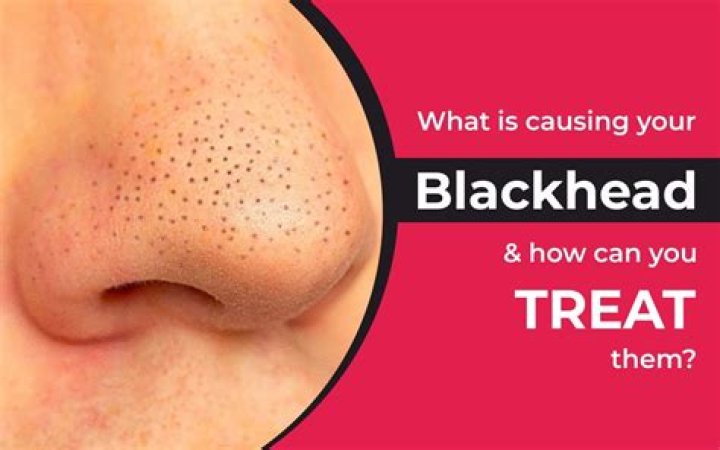 What foods cause blackheads?