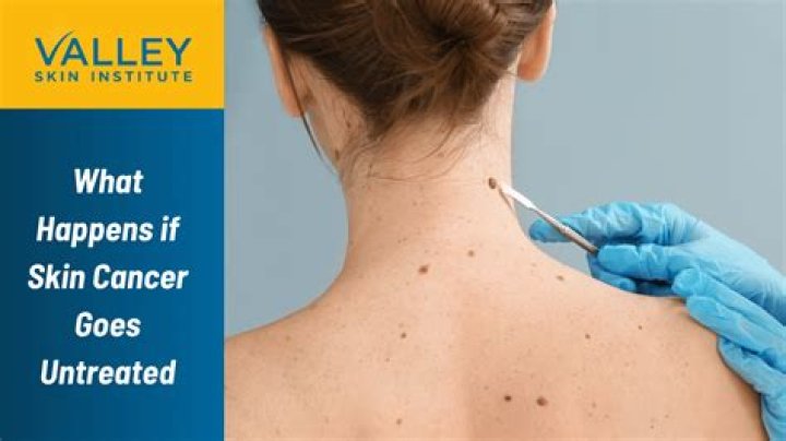 What happens if Sjogren's goes untreated?