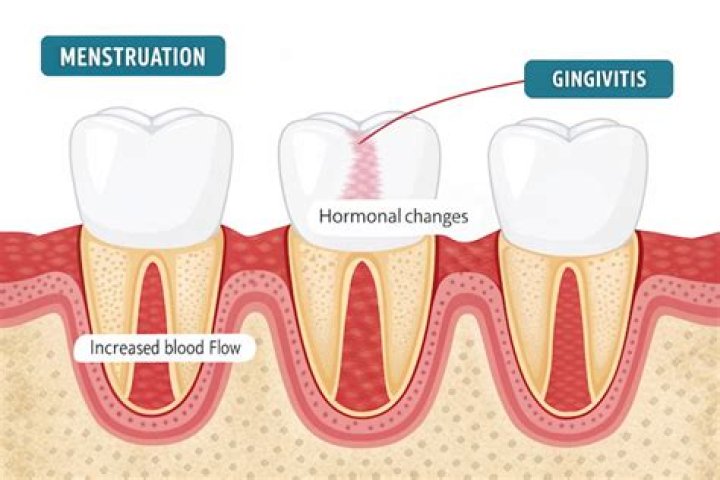What Is menstruation gingivitis?