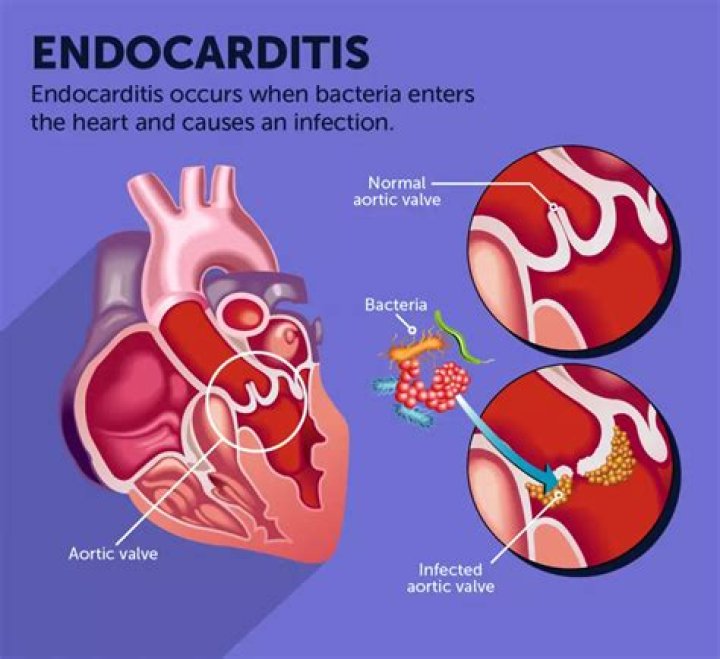 What is subacute endocarditis?