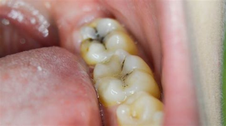 What is the black stuff inside my tooth?