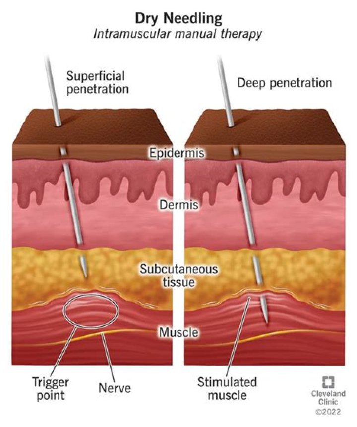 What is the difference between dry needling and trigger point injections?