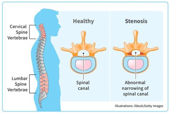 What is the difference between lumbar stenosis and spinal stenosis?