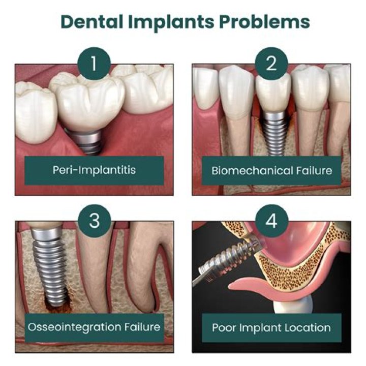 What is the most common cause of implant failure?