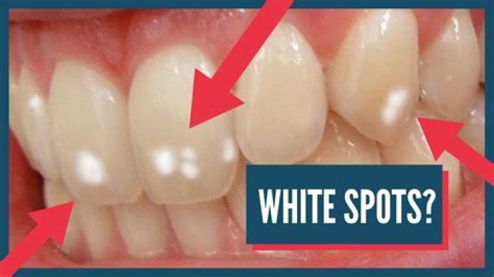 What is the white stuff that comes off your teeth?