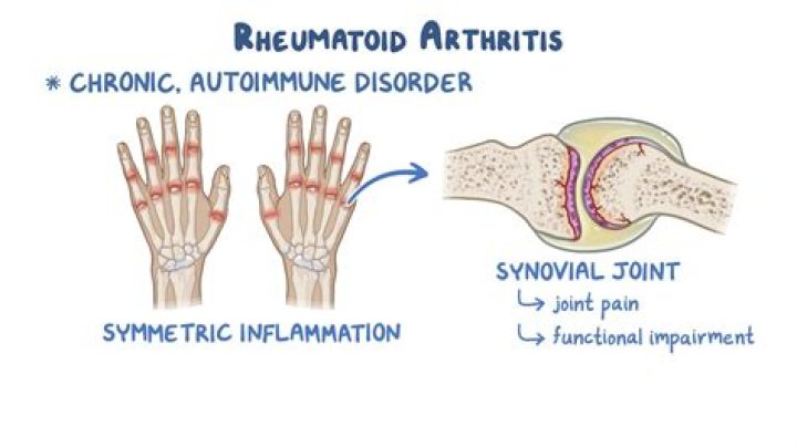 What kind of arthritis makes you hurt all over?