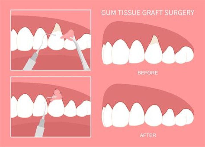 What kind of sedation is used for a gum graft?
