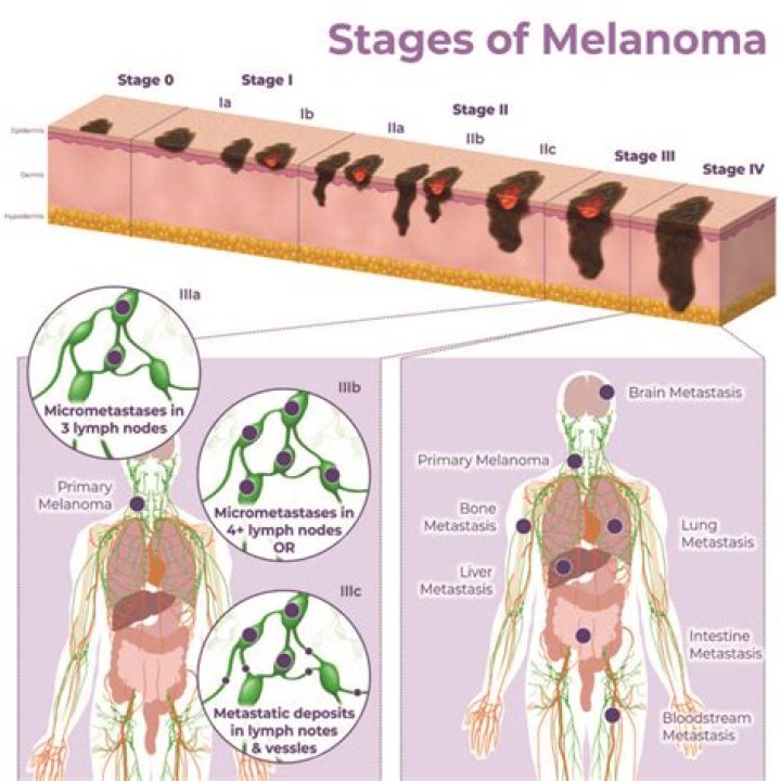 What percentage of melanoma is hereditary?