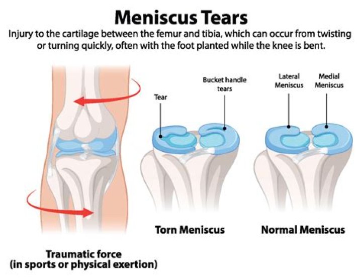 What percentage of meniscus tears require surgery?