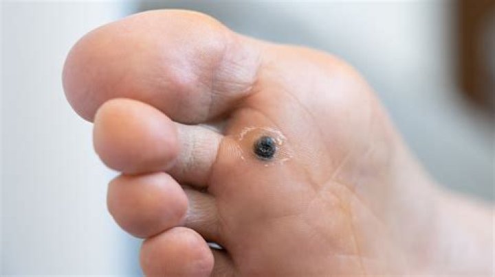 When is a wart no longer contagious?