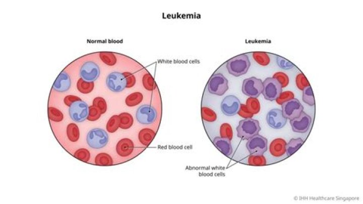 When should I worry about leukemia?