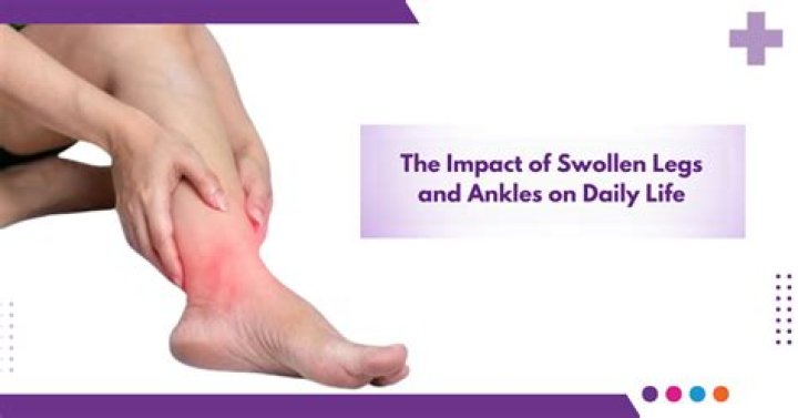 When should you go to the hospital for swollen feet and legs?